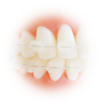 審美ブラケットとホワイトワイヤー